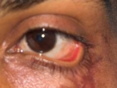 स्किन ग्राफ्टिंग से मरीज के पलक का सफल पुनर्निर्माण